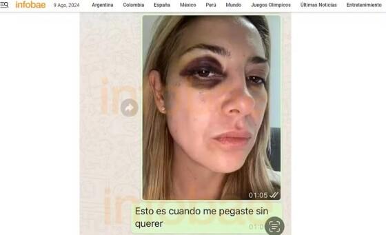 Ex-primeira-dama mostra hematomas após agressões de Alberto Fernández, diz site