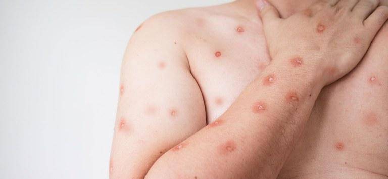 Rondônia confirma 5 novos casos da Mpox e Mato Grosso entra em alerta
