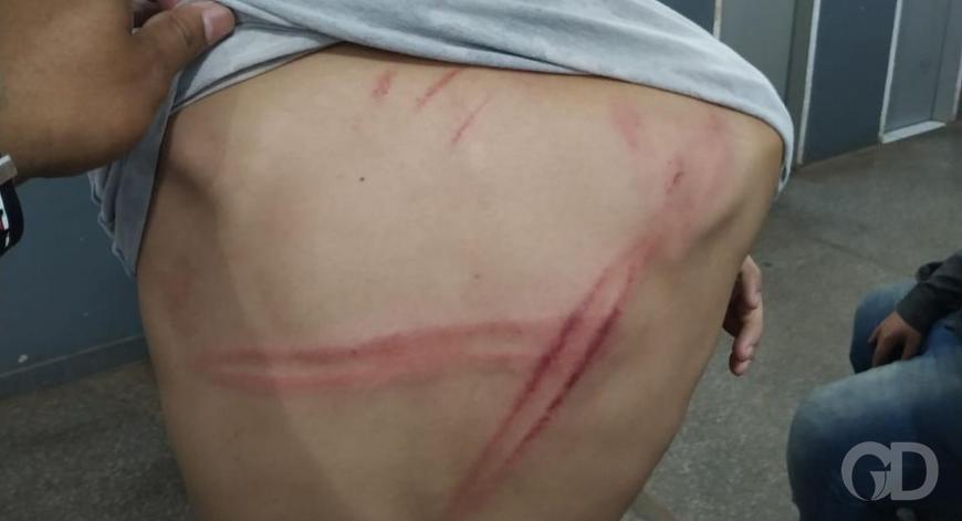  Padrasto furioso agride menor de 14 anos com cabo de vassoura e costas da vítima fica em “petição de miséria”